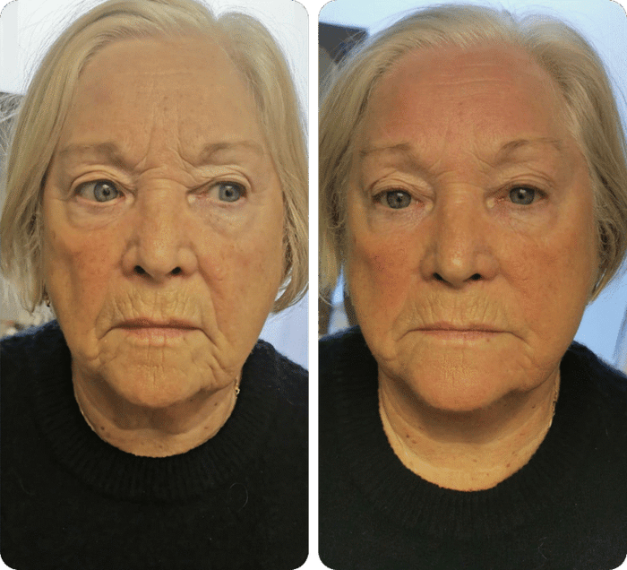 Before and after RF microneedling result 5