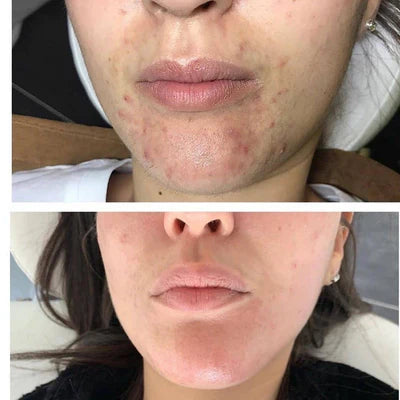 Before and after RF microneedling result 6