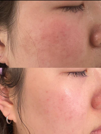 Before and after RF microneedling result 1