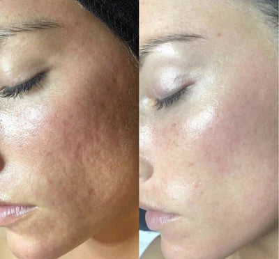 Before and after RF microneedling result 2