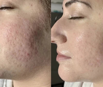 Before and after RF microneedling result 3