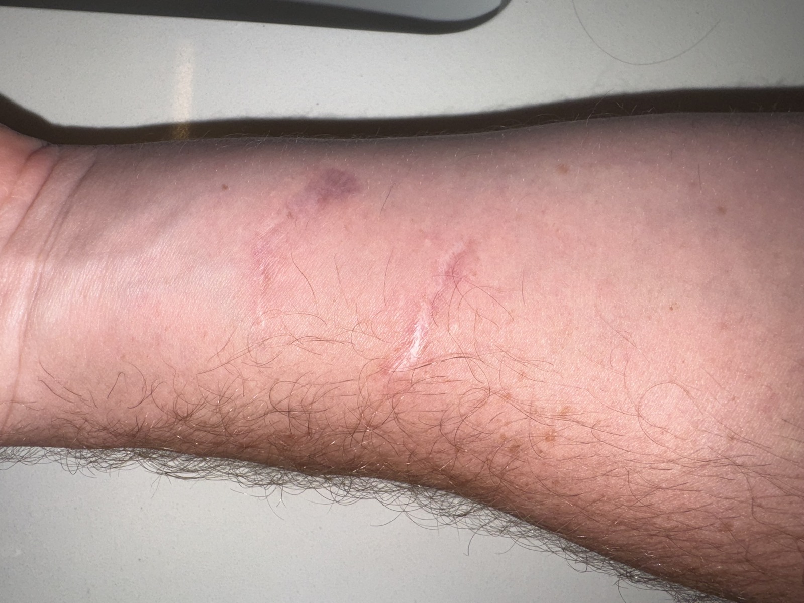 After treatment: Nathan's forearm with the bite scars faded and flattened following RF microneedling