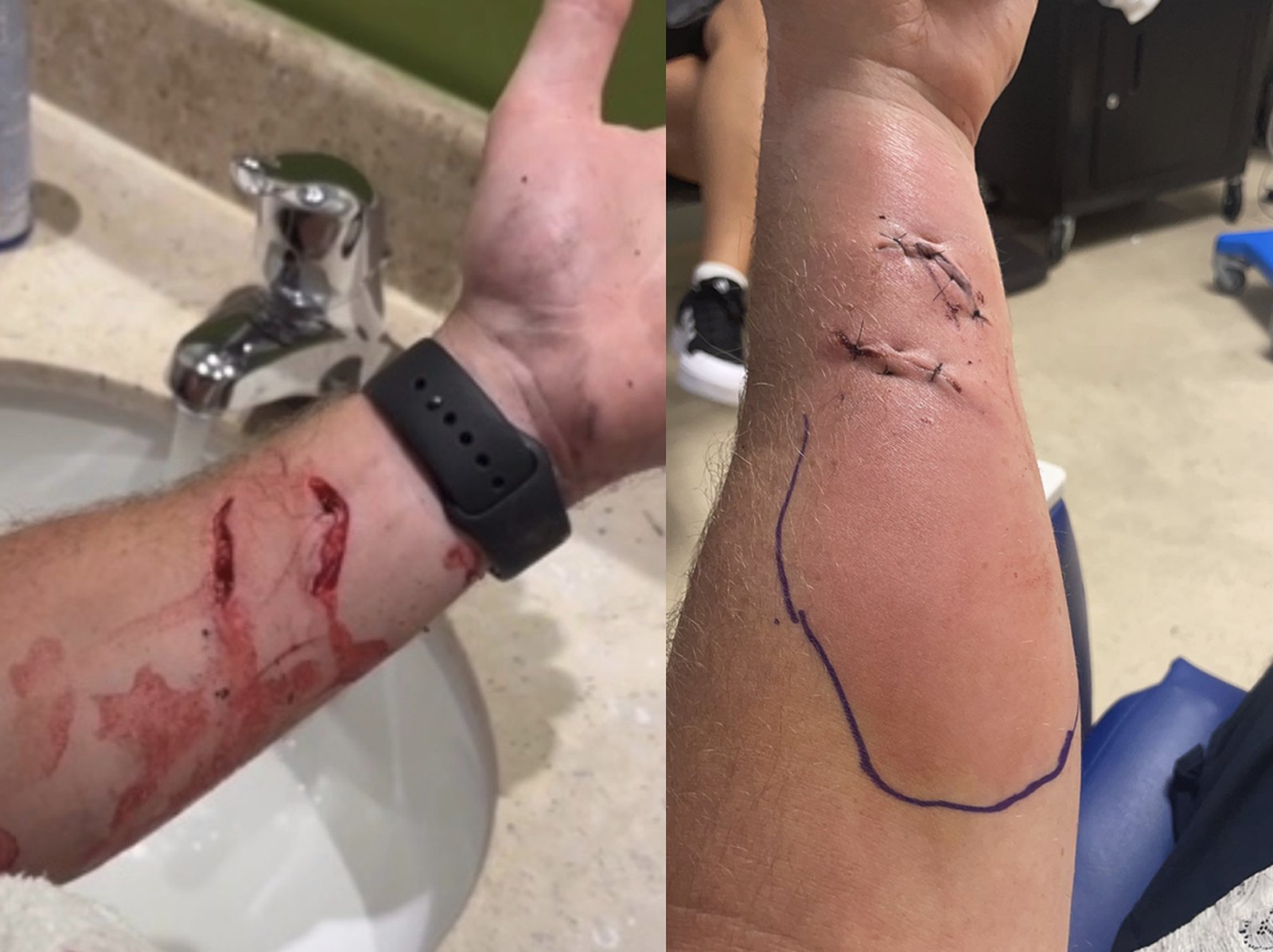 Before treatment: the animal bite on Nathan's forearm, fresh and after suturing