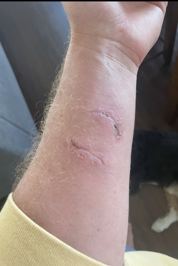 Nathan's forearm, before treatment