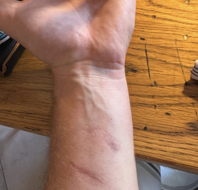 Nathan's forearm, after the 1st session