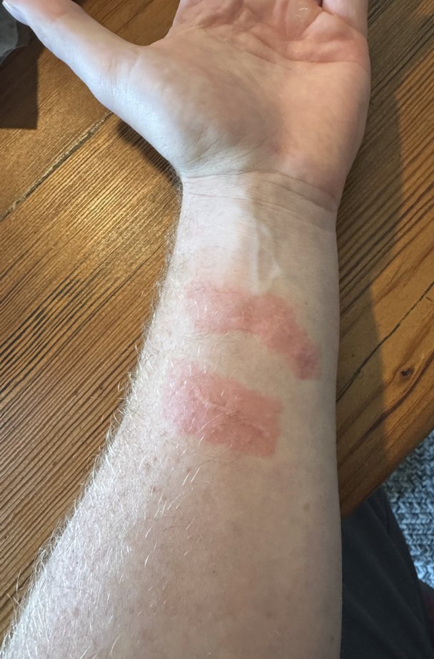 Nathan's forearm, 1 day after the 2nd session