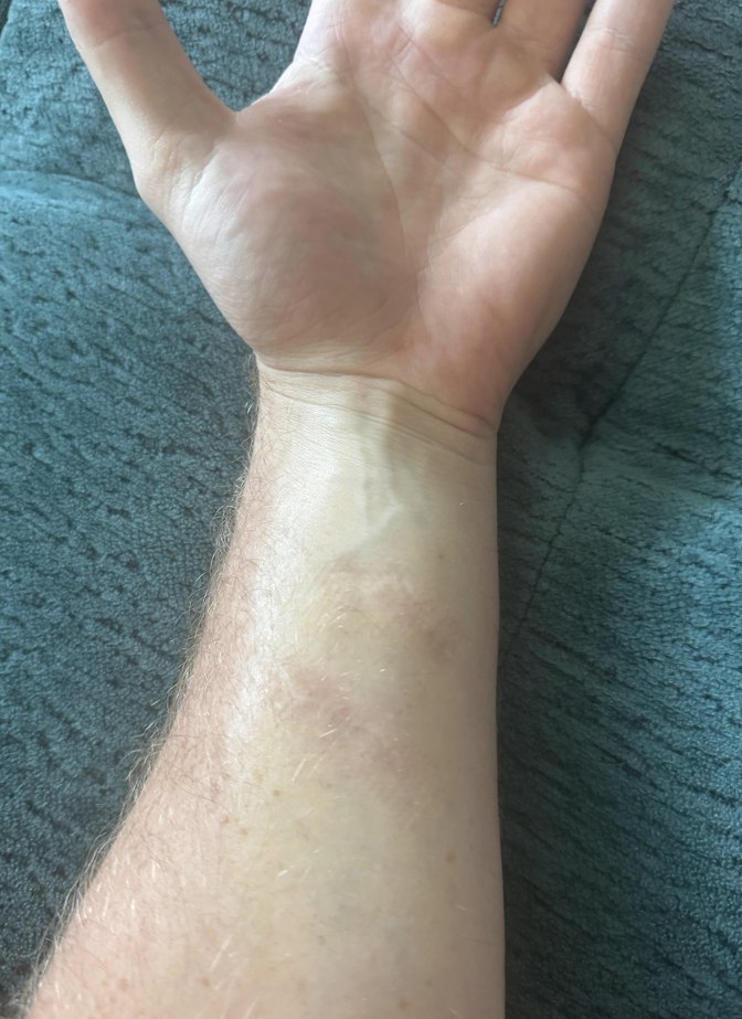 Nathan's forearm, 2 months after the 2nd session